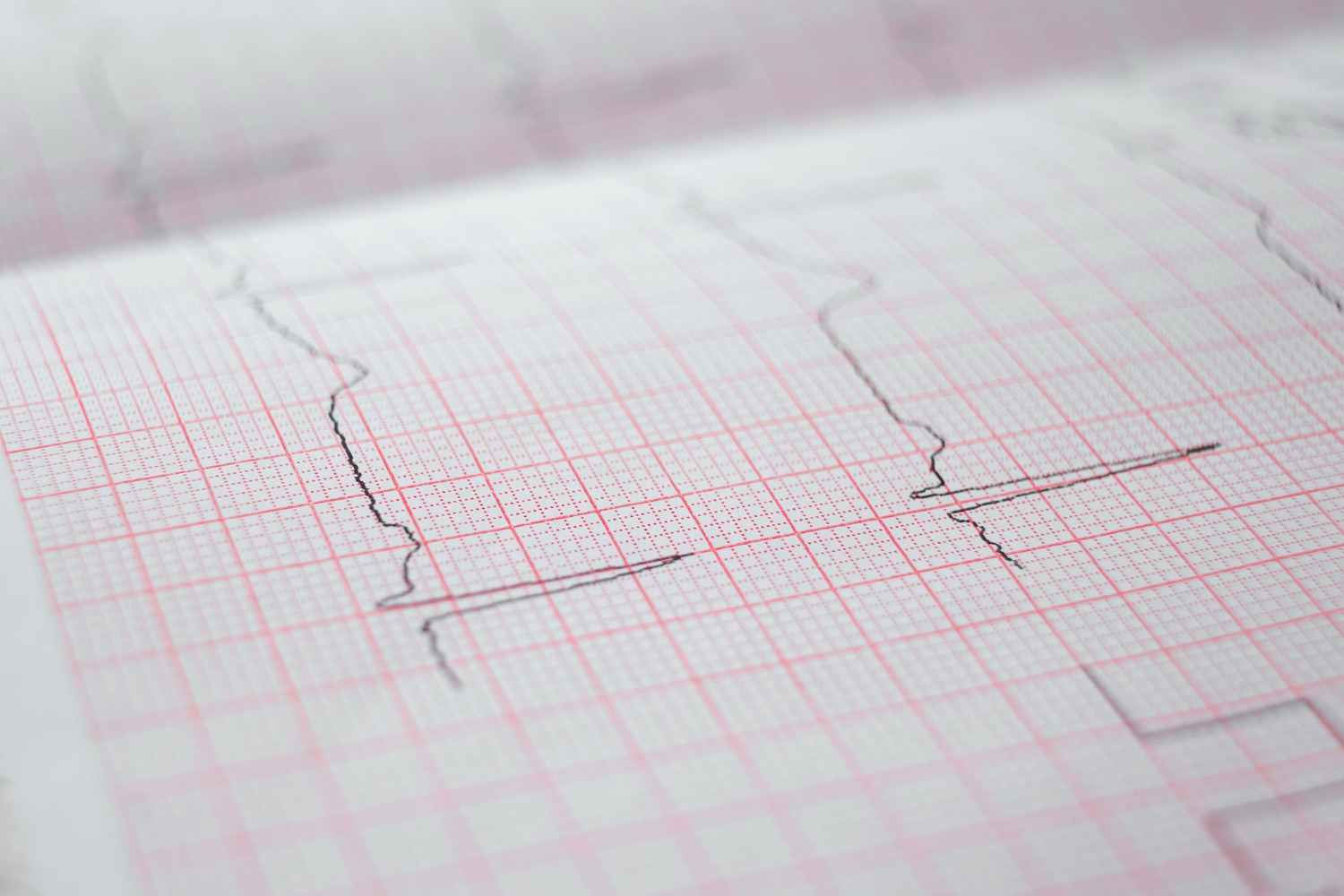HaloScape study on heart attack screening from paper ECG images published on a leading global engineering and technology platform